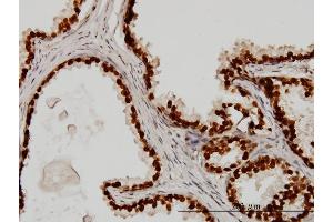 Immunoperoxidase of monoclonal antibody to FOXA1 on formalin-fixed paraffin-embedded human prostate.