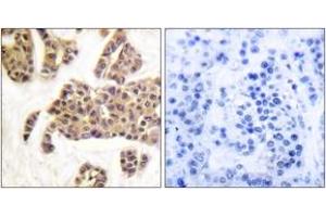 Immunohistochemistry analysis of paraffin-embedded human breast carcinoma, using BAD (Phospho-Ser91/128) Antibody.