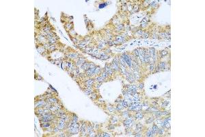 Immunohistochemistry of paraffin-embedded human colon carcinoma using GLUD1 antibody.