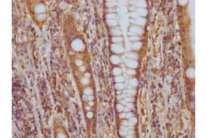 IHC image of ABIN7127577 diluted at 1:100 and staining in paraffin-embedded human colon cancer performed on a Leica BondTM system.