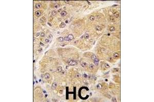 Formalin-fixed and paraffin-embedded human hepatocarcinoma tissue reacted with SOST antibody (Center) (ABIN390194 and ABIN2840683) , which was peroxidase-conjugated to the secondary antibody, followed by DAB staining.