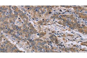 Immunohistochemistry of paraffin-embedded Human liver cancer tissue using GSN Polyclonal Antibody at dilution 1:40 (Gelsolin anticorps)