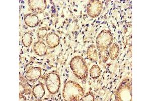 Immunohistochemistry of paraffin-embedded human gastric cancer using ABIN7160084 at dilution of 1:100 (BUB1 anticorps  (AA 256-577))