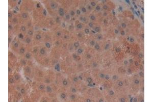 Detection of LILRB2 in Human Liver cancer Tissue using Polyclonal Antibody to Leukocyte Immunoglobulin Like Receptor Subfamily B, Member 2 (LILRB2)