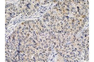 SQSTM1/p62 Mouse Monoclonal Antibody at 1/100 staining human lung cancer by IHC-P. (SQSTM1 anticorps  (C-Term))