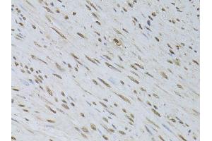 Immunohistochemistry of paraffin-embedded human uterine cancer using HDGFRP3 antibody (ABIN5995765) at dilution of 1/100 (40x lens).