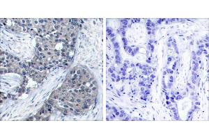 P-Peptide - +Immunohistochemical analysis of paraffin-embedded human breast carcinoma tissue using elF4E (phospho- Ser209) antibody. (EIF4E anticorps  (pSer209))