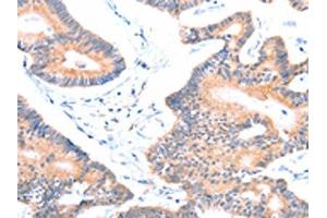 The image on the left is immunohistochemistry of paraffin-embedded Human colon cancer tissue using ABIN7128444(AOC1 Antibody) at dilution 1/15, on the right is treated with fusion protein. (DAO anticorps)