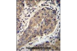 WTIP Antibody (C-term) (ABIN655782 and ABIN2845217) immunohistochemistry analysis in formalin fixed and paraffin embedded human hepatocarcinoma followed by peroxidase conjugation of the secondary antibody and DAB staining. (WTIP anticorps  (AA 243-271))
