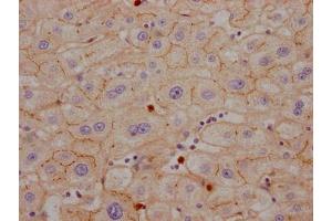 IHC image of ABIN7127422 diluted at 1:100 and staining in paraffin-embedded human liver cancer performed on a Leica BondTM system. (Recombinant CEACAM1 anticorps)