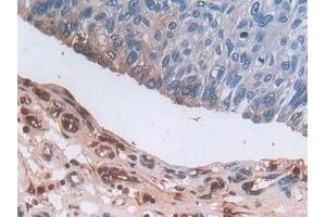 Detection of DEFa3 in Human Prostate cancer Tissue using Polyclonal Antibody to Defensin Alpha 3, Neutrophil Specific (DEFa3)