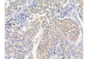 ABIN6261427 and ABIN6279413 at 1/100 staining human lung squamous cell carcinoma by IHC-P.