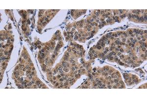 Immunohistochemistry of paraffin-embedded Human breast cancer tissue using IPO8 Polyclonal Antibody at dilution 1:50 (Importin 8 anticorps)
