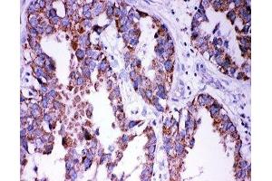 IHC-P: DISC1 antibody testing of human lung cancer tissue (DISC1 anticorps  (Middle Region))