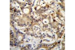 Immunohistochemistry analysis in human colon carcinoma (Formalin-fixed, Paraffin-embedded) using SP1 / TSFP1  Antibody (C-term), followed by peroxidase conjugation of the secondary antibody and DAB staining.