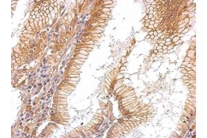 IHC-P Image EGFR antibody [C2C3], C-term detects EGFR protein at membrane on human gastric cancer by immunohistochemical analysis. (EGFR anticorps  (C-Term))