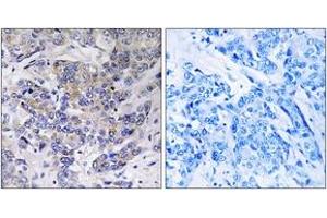 Immunohistochemistry analysis of paraffin-embedded human breast carcinoma tissue, using RPS21 Antibody. (RPS21 anticorps  (AA 31-80))