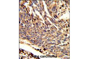 Formalin-fixed and paraffin-embedded human lung carcinoma reacted with ARPC1B Antibody , which was peroxidase-conjugated to the secondary antibody, followed by DAB staining. (ARPC1B anticorps  (AA 159-188))