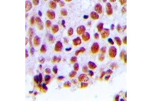 Immunohistochemical analysis of MSH2 staining in human breast cancer formalin fixed paraffin embedded tissue section.
