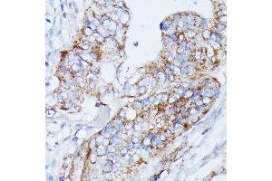 Immunohistochemistry of paraffin-embedded human colon carcinoma using MANBA antibody (ABIN7268392) at dilution of 1:100 (40x lens). (MANBA anticorps  (AA 18-300))