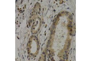 Immunohistochemistry of paraffin-embedded human stomach cancer using MAGEA1 antibody at dilution of 1:200 (400x lens). (MAGEA1 anticorps)
