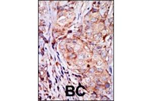 Formalin-fixed and paraffin-embedded human cancer tissue reacted with the primary antibody, which was peroxidase-conjugated to the secondary antibody, followed by AEC staining.