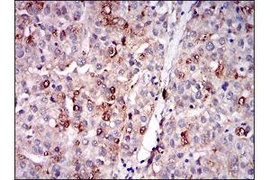 Immunohistochemical analysis of paraffin-embedded liver cancer tissues using PLIN2 mouse mAb with DAB staining. (ADRP anticorps  (AA 286-437))