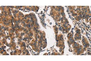 Immunohistochemistry of paraffin-embedded Human breast cancer using ITGA2 Polyclonal Antibody at dilution of 1:30 (ITGA2 anticorps)