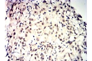 Immunohistochemical analysis of paraffin-embedded baldder cancer tissues using TDP43 mouse mAb with DAB staining.