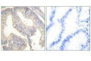 Immunohistochemical analysis of paraffin-embedded human colon carcinoma tissue using Gastrin antibody. (Gastrin anticorps)