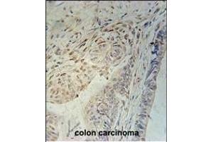 CCD92 Antibody (Center) (ABIN651208 and ABIN2840130) immunohistochemistry analysis in formalin fixed and paraffin embedded human colon carcinoma followed by peroxidase conjugation of the secondary antibody and DAB staining.
