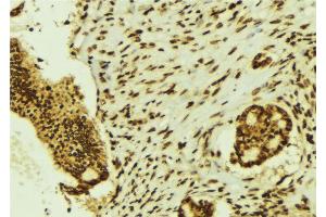 ABIN6274464 at 1/100 staining Human breast cancer tissue by IHC-P. (BRF1 anticorps  (Internal Region))