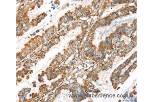 Immunohistochemistry of Human esophagus cancer using LOXL4 Polyclonal Antibody at dilution of 1:35