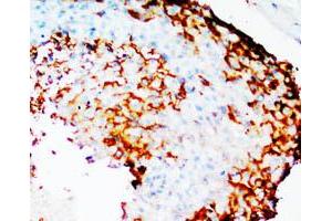 Immunohistochemical staining of PTGS2 on formalin fixed, paraffin embedded human mammary cancer with PTGS2 polyclonal antibody . (PTGS2 anticorps  (N-Term))