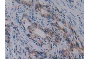 Detection of PKBb in Human Stomach cancer Tissue using Polyclonal Antibody to Protein Kinase B Beta (PKBb) (AKT2 anticorps  (AA 142-412))