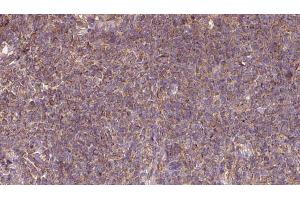 ABIN6273113 at 1/100 staining Human lymph cancer tissue by IHC-P. (DNAJC10 anticorps  (C-Term))