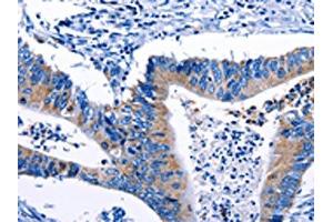 The image on the left is immunohistochemistry of paraffin-embedded Human colon cancer tissue using ABIN7193124(Gjc3 Antibody) at dilution 1/10, on the right is treated with synthetic peptide. (GJC3 anticorps)