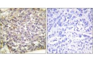 Immunohistochemistry analysis of paraffin-embedded human breast carcinoma tissue, using 14-3-3 zeta (Ab-58) Antibody.