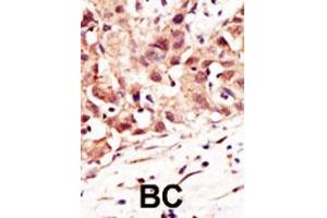 Formalin-fixed and paraffin-embedded human cancer tissue reacted with the primary antibody, which was peroxidase-conjugated to the secondary antibody, followed by DAB staining.