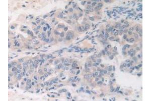 IHC-P analysis of Human Breast Cancer Tissue, with DAB staining. (FDFT1 anticorps  (AA 269-417))