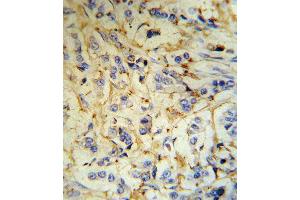 FGA Antibody (RB18707) IHC analysis in formalin fixed and paraffin embedded human breast carcinoma tissue followed by peroxidase conjugation of the secondary antibody and DAB staining.