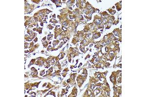 Immunohistochemistry of paraffin-embedded human liver cancer using C2 Rabbit pAb (ABIN7265549) at dilution of 1:100 (40x lens).