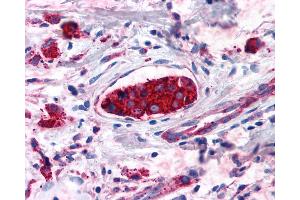 Anti-CNR2 / CB2 antibody IHC of human Breast, Carcinoma. (CNR2 anticorps  (Cytoplasmic Domain))