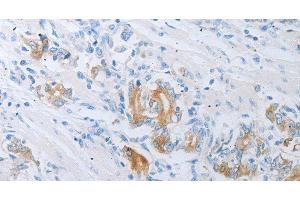 Immunohistochemistry of paraffin-embedded Human gastric cancer using LOX Polyclonal Antibody at dilution of 1:30