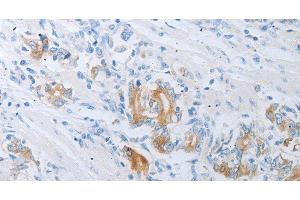 Immunohistochemistry of paraffin-embedded Human gastric cancer using LOX Polyclonal Antibody at dilution of 1:30 (LOX anticorps)