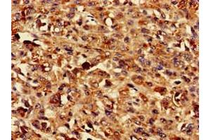 Immunohistochemistry of paraffin-embedded human melanoma using ABIN7173215 at dilution of 1:100 (TMEM43 anticorps  (AA 178-312))