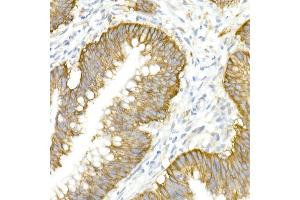 Immunohistochemistry of paraffin-embedded human colon carcinoma using SLC12 Rabbit pAb (ABIN6131136, ABIN6147843, ABIN6147844 and ABIN6215366) at dilution of 1:50 (40x lens). (SLC12A2 anticorps  (AA 120-280))
