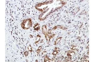 IHC-P Image Immunohistochemical analysis of paraffin-embedded Human pancreatic tumor, using CXCR7, antibody at 1:100 dilution. (CXCR7 anticorps)