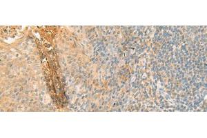 Immunohistochemistry of paraffin-embedded Human tonsil tissue using GPT2 Polyclonal Antibody at dilution of 1:70(x200) (GPT2 anticorps)