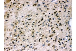 Anti- PPP1R12A Picoband antibody,IHC(P) IHC(P): Human Glioma Tissue (PPP1R12A anticorps  (N-Term))